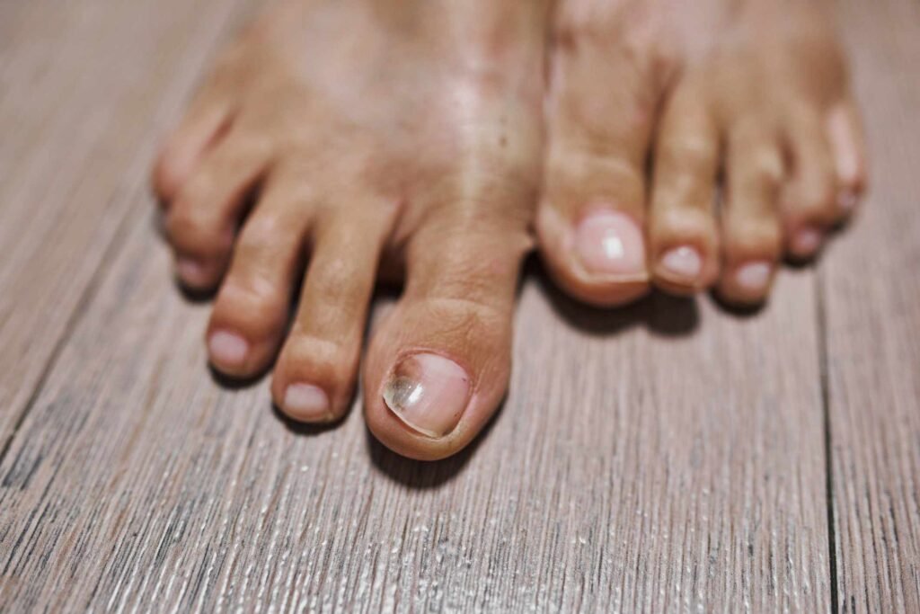 How to prevent damaged toenails in the future