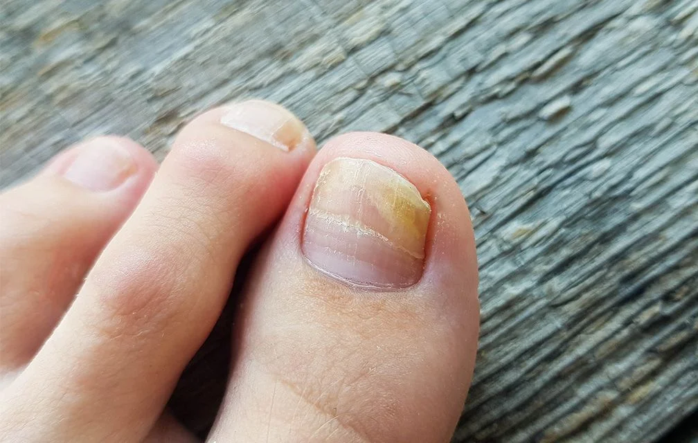 How to Treat Damaged Toenails at Home